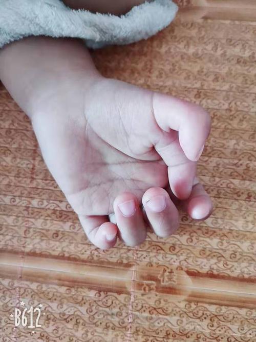 【天眼见证】儿子先天性六指畸形,原因竟然是我拿了不