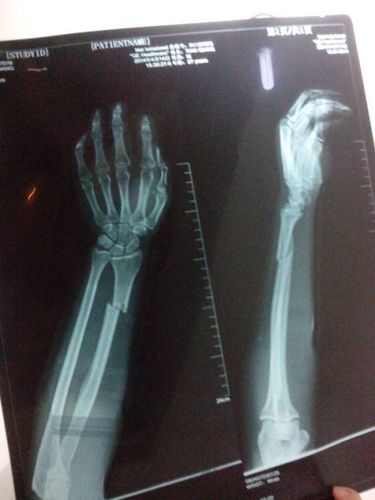 我的左手桡骨远端骨折.在医院医生接上过后就上了4块夹板.