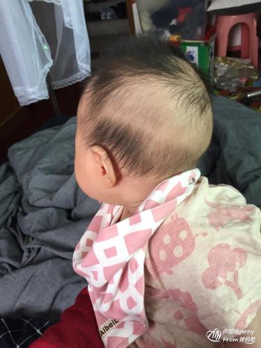 后脑勺有疤不长头发运势宝宝后脑勺不长头发怎么回事