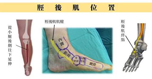 胫骨后肌功能不全的临床表现及治疗策略_肌腱
