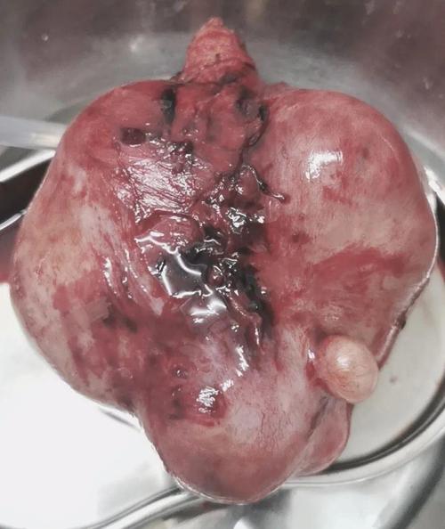 石屏同仁医院妇科成功摘除一例巨大子宫肌瘤!