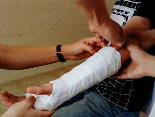 骨折必须开刀?专家用实例告诉你:不一定哦
