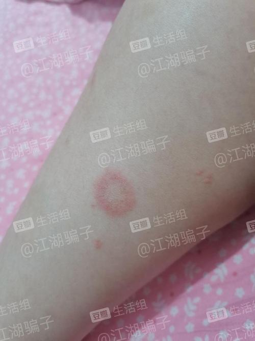 可以帮我看看是不是钱币样湿疹吗(有图慎入