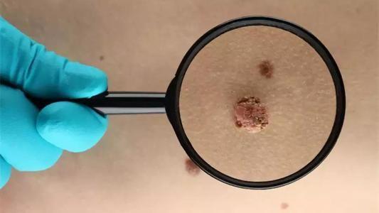 hpv病毒感染早期会有症状么?如何才能转阴?