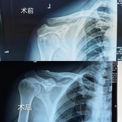 国际蒙医院骨伤科今日成功完成一例肩锁关节脱位肩关节镜喙锁韧带重建