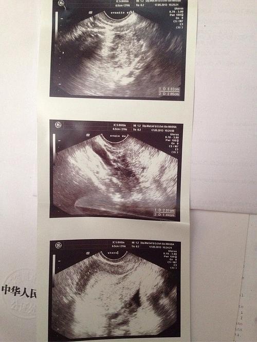 人在国外做了一个阴超,因为xxoo的时候会出血,医生说没事.