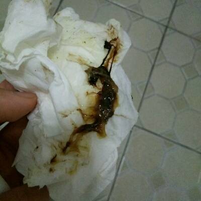 凝胶,但用后第二天开始排出粘膜状黑色血块状,然后就是咖啡色豆腐渣状