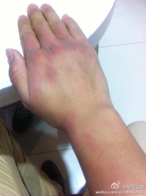 谁知道怎么弄啊 轻度烧伤?