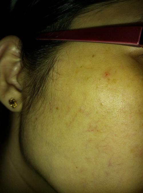 请问哪位懂医的人士们,这是不是颚口线虫?