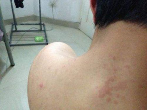 艾滋病一半在中国?不论男女,脖子上出现"3大症状",别