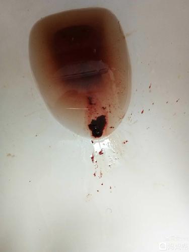 2018-1-25号宝宝自然流产了,可能