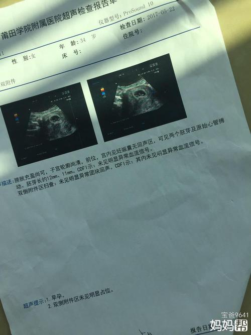 50天b超同卵双胞胎,二胎