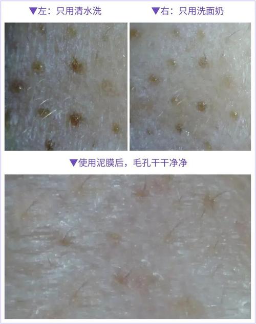 买一送一|毛孔大扫除!养了20年的闭口,黑头,就这样被一锅端了?
