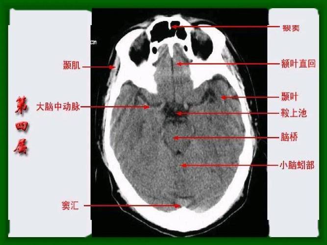 头颅ct 解剖图谱,人手一份