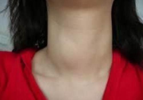 甲状腺结节早期症状有哪些出现一定要尽早治疗