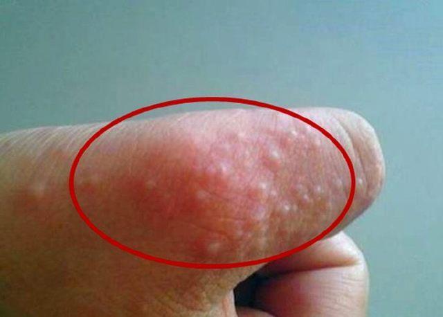身上起小水泡, 被你忽视, 这其实是身体发出的健康