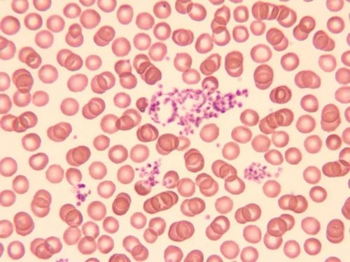 形态学报告中血小板应该如何描述|经验分享