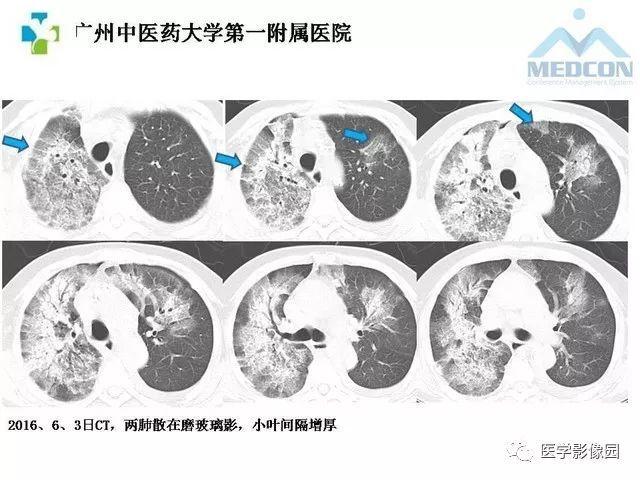 病毒性肺炎影像诊断与鉴别诊断 | 影像天地