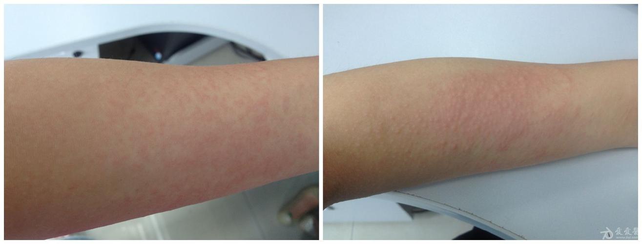 前几天感冒 吃了感冒药的,会不会是过敏