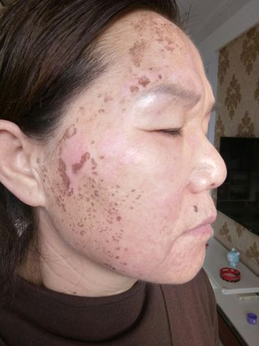 美丽之旅(我的祛斑经历)