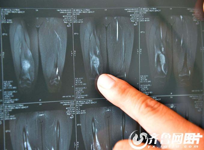 烟台10岁男孩患骨癌面临截肢我喜欢看大海