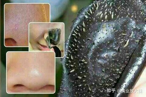 怎么把鼻子上的小黑毛去干净?
