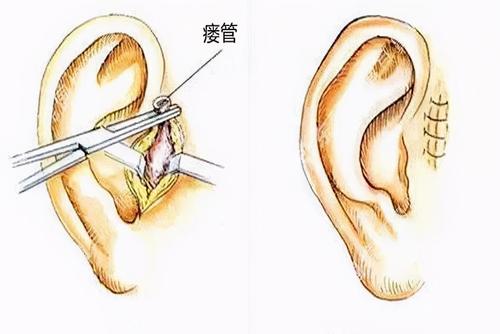 耳前长这种小洞千万别挤感染后免不了要挨几刀