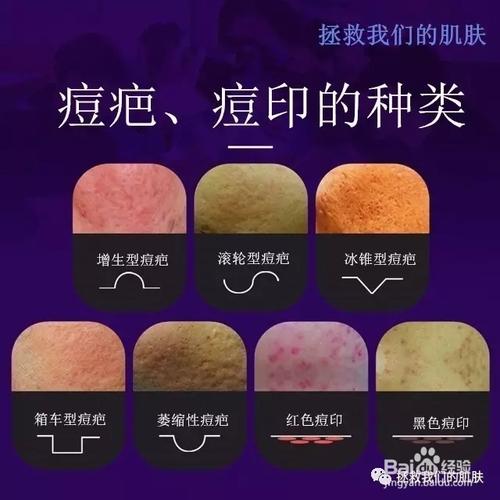 痘印也分为两种红色的痘印及黑色的痘印.