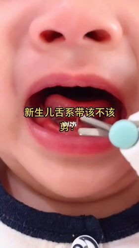 新生儿92可用手指将舌头抬起,若舌系带附着于舌尖处