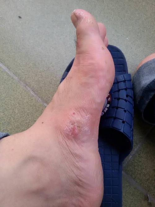 像我这样的顽固性脚气烂脚丫,有没有救了,都快10年了?