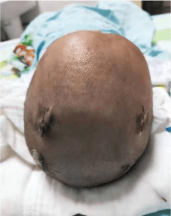 颅骨长成这样,不"整"会出大问题!