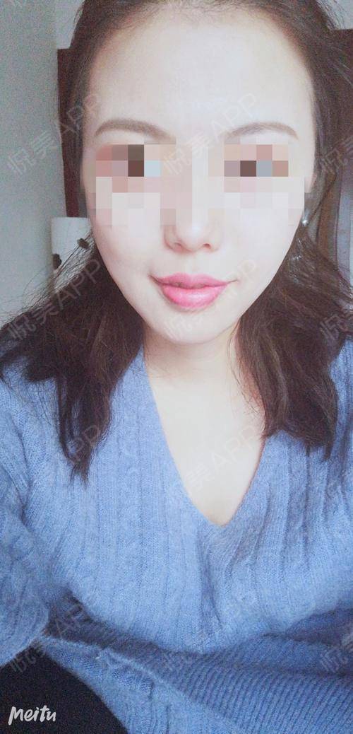 厚唇改薄术后100天_m唇手术术后100天_唇形矫正术后100天_唇型美化术