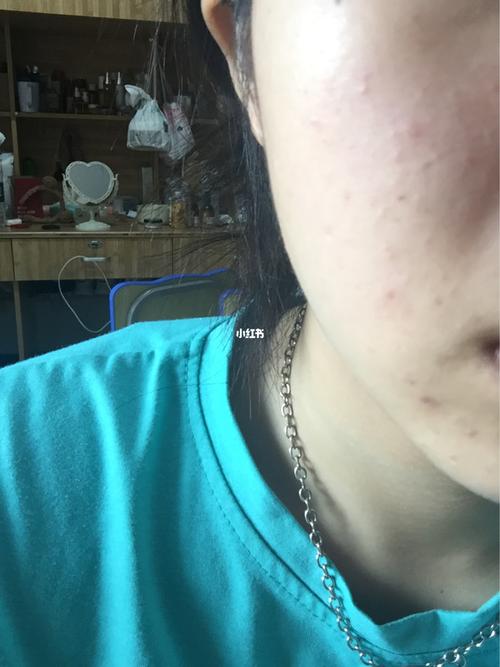 这是过敏吗_过敏_欧诗漫怎么样_护肤品_美妆_护肤