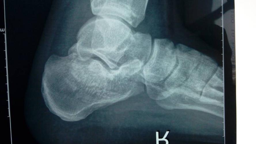 男42岁,跟骨骨折