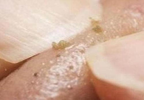 鼻子上挤出"黄粒粒",螨虫挤在里面爬,学2招,逼退螨虫