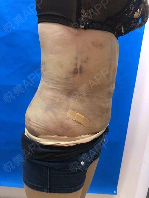 做完水动力腰腹环吸脂已经有7天了!姐妹们!我终于熬.瘦全身_悦美整形