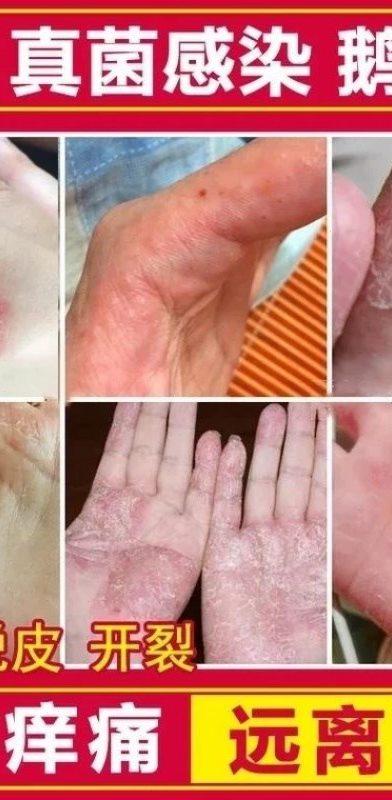 汗疱疹手指脚上起小水泡汗泡疹膏湿疹止痒去根手足藓感染药膏