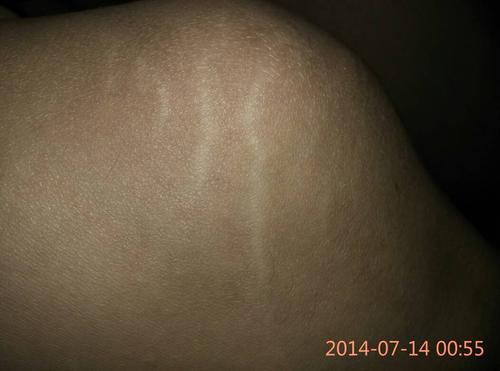 为什么我大腿和膝盖有一条条白纹.
