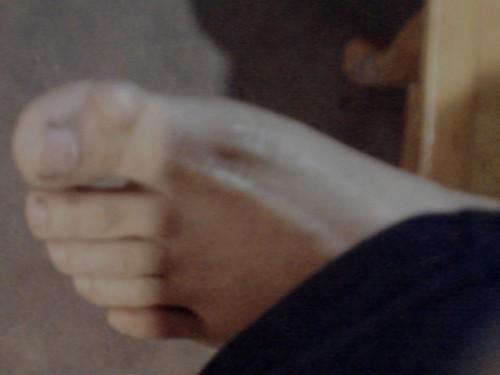 边上今年才有点透明,其他是皮肤色 想得到怎样的帮助: 请问腱鞘囊肿与