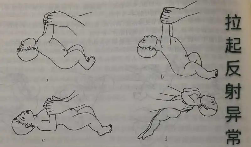 孩子是否患有脑瘫? "七种姿势"教您来判断