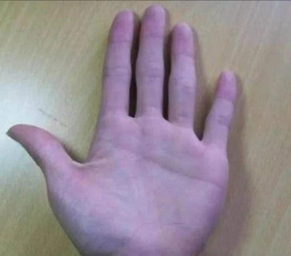 手掌出现"青筋"说明什么?肝不好,痔疮大,血管老