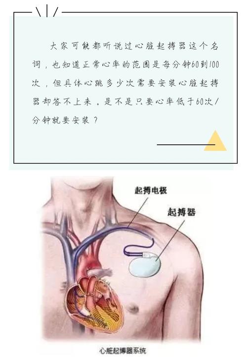 心脏起搏器植入术 - 好大夫