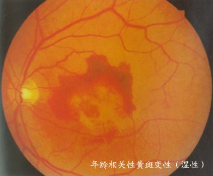 年龄相关性黄斑变性