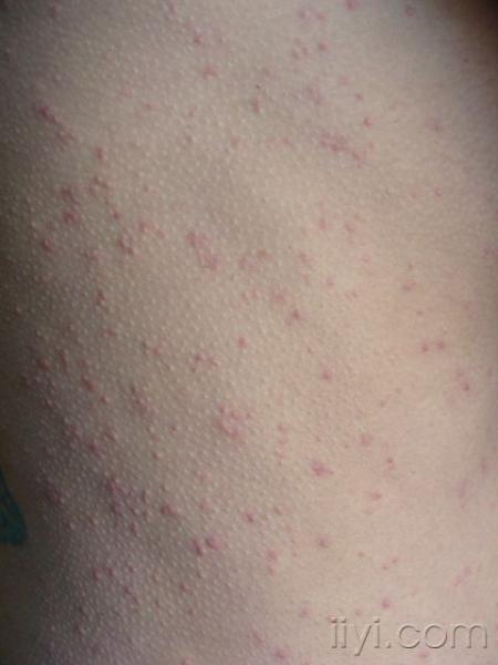 过敏性皮炎?湿疹?