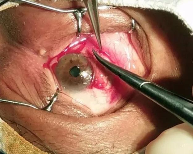 康燕可翼状胬肉手术全过程