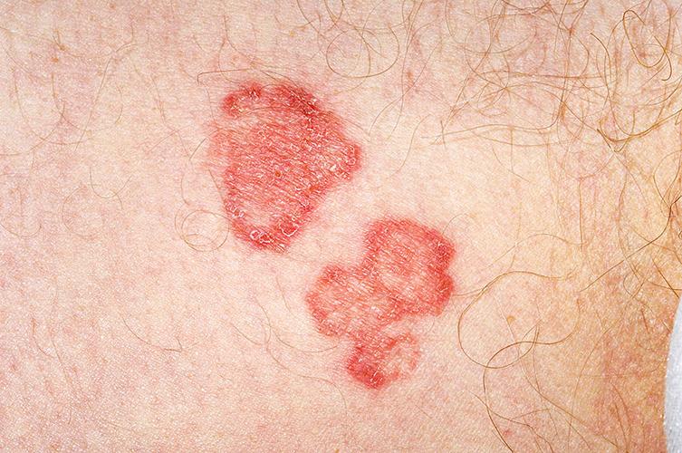 感染,60岁,男人,运动员,痒,疾病,真菌,皮,罐,多样,菌类,传染性,污染