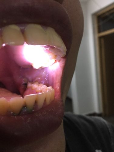 左边智齿上下都拔掉了,今天第二天,口腔里左边的肉全都白掉了,没事吧?