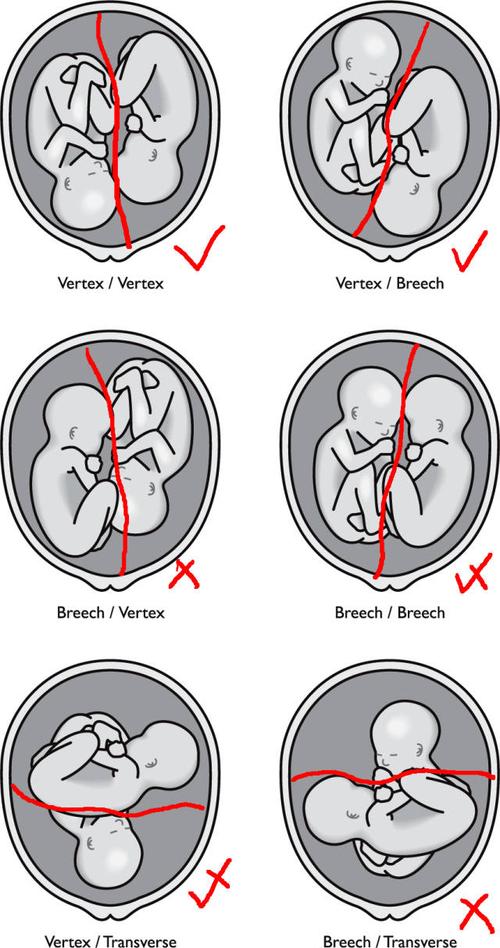 多图读懂:双胞胎到底怎么生?