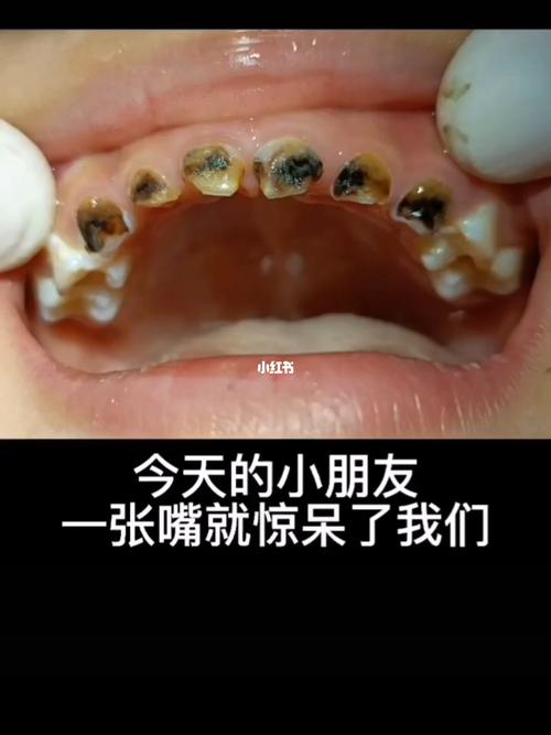 反正乳牙都要换,儿童蛀牙不用管?