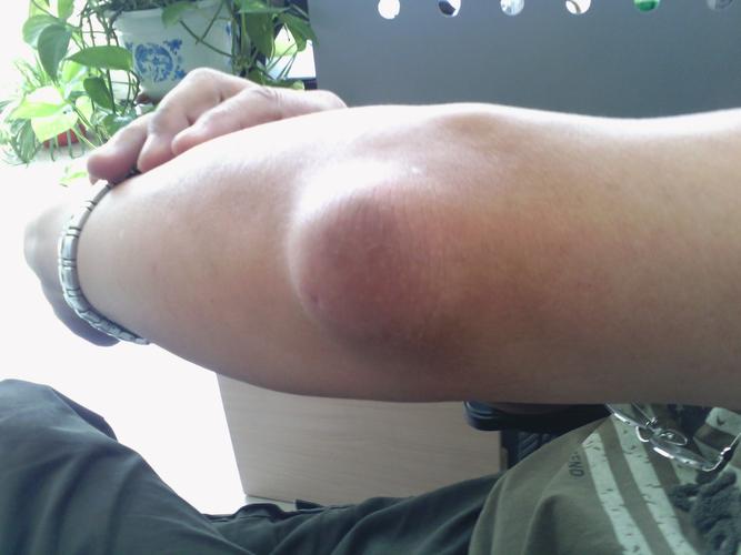 同事的胳膊肘上长了个大包,不痛也不痒,因工作忙还来不及看医生,请懂